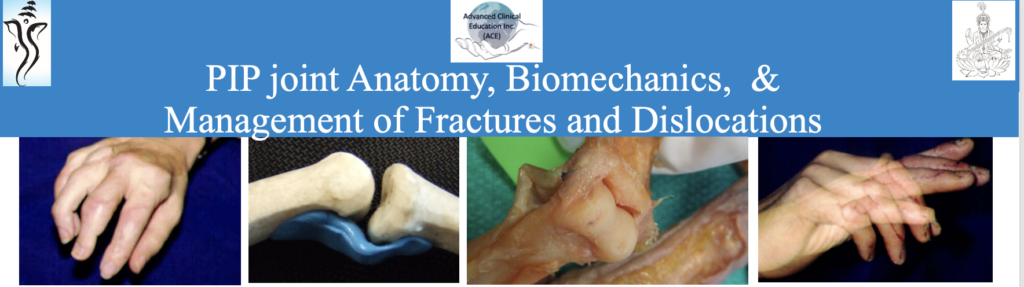 PIP Joint Anatomy, Biomechanics, & the Management of Fractures and Dislocations