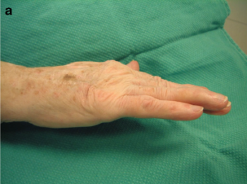 When digits are passively placed into extension, patients are able to actively hold them in place
