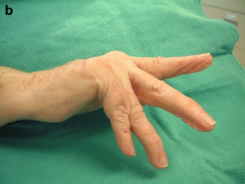 However, a sagittal band rupture is evident if patients are unable to actively extend their digits from a flexed position.