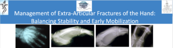 Management of Extra-Articular Fractures of the Hand: Balancing Stability and Early Mobilization
